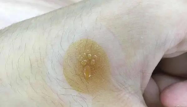 灸花，一種奇妙的花