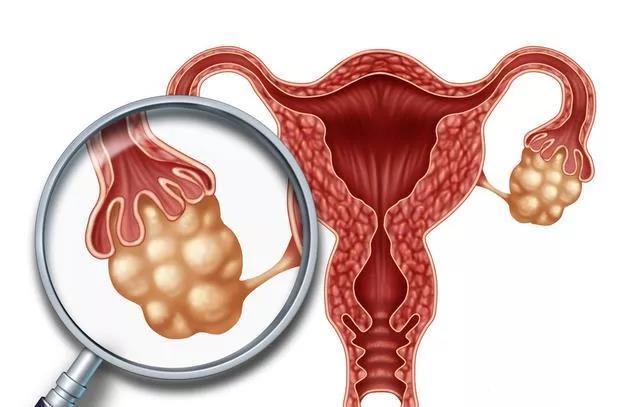 婦科“第一兇癌”！當出現這些癥狀時(shí)，婦科問(wèn)題艾灸灸什么穴位