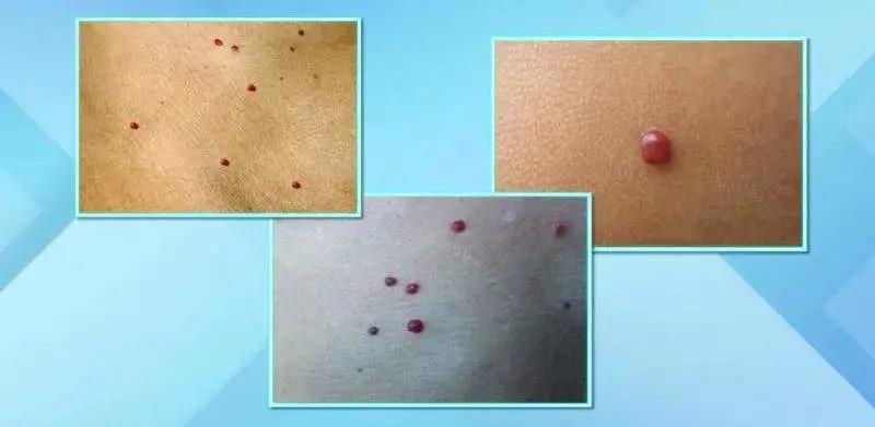 身上莫名其妙的出現血痣，怎么辦？