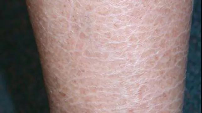 魚(yú)鱗皮膚是缺水表現嗎，問(wèn)題出在這里